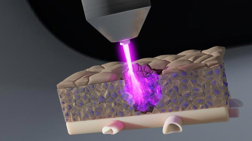 Cold Plasma Jet Technology Penetrates Deep Tissue Layers to Target Cancer Cells Engineering News