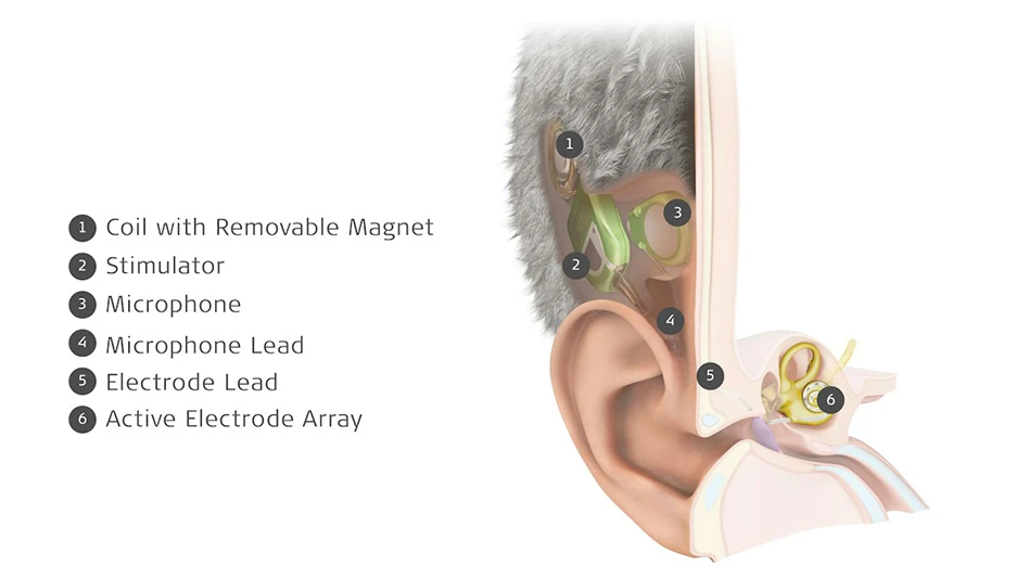 Fully Implanted Cochlear Implant: The Invisible Device Restoring Hearing Without External Hardware Engineering News